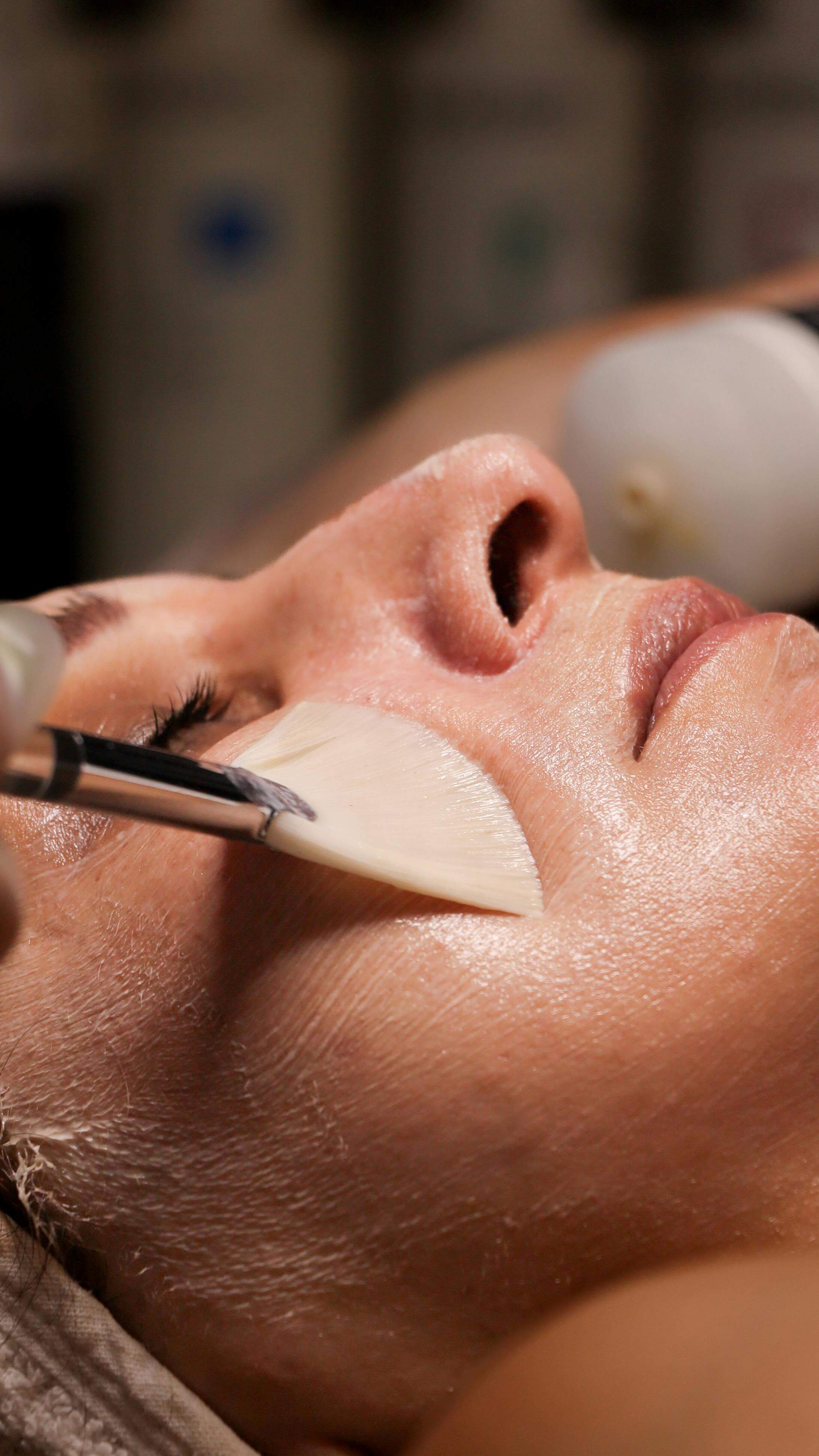 Supernatural | Chemical Peel