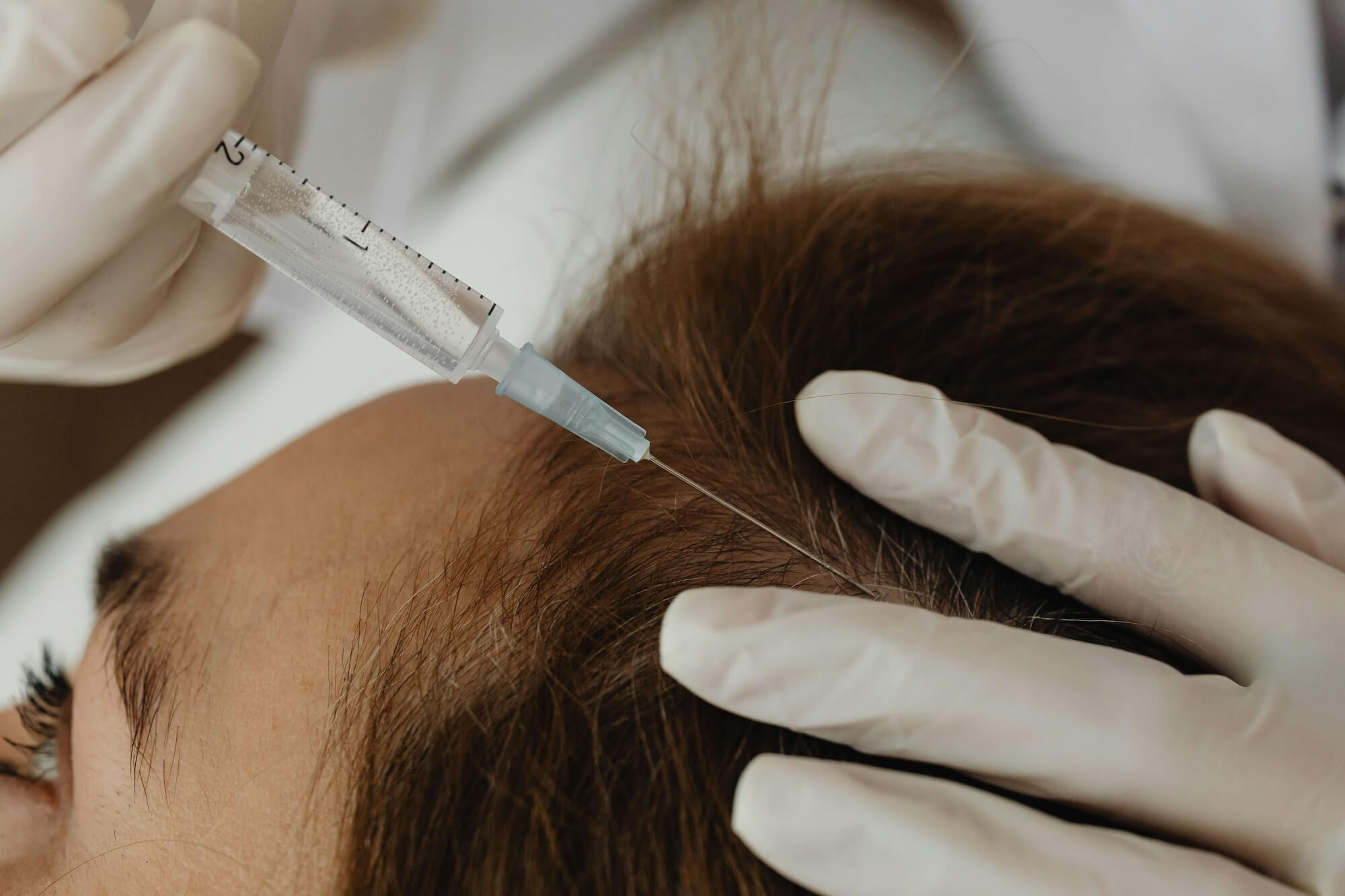 Supernatural | Hair Restoration